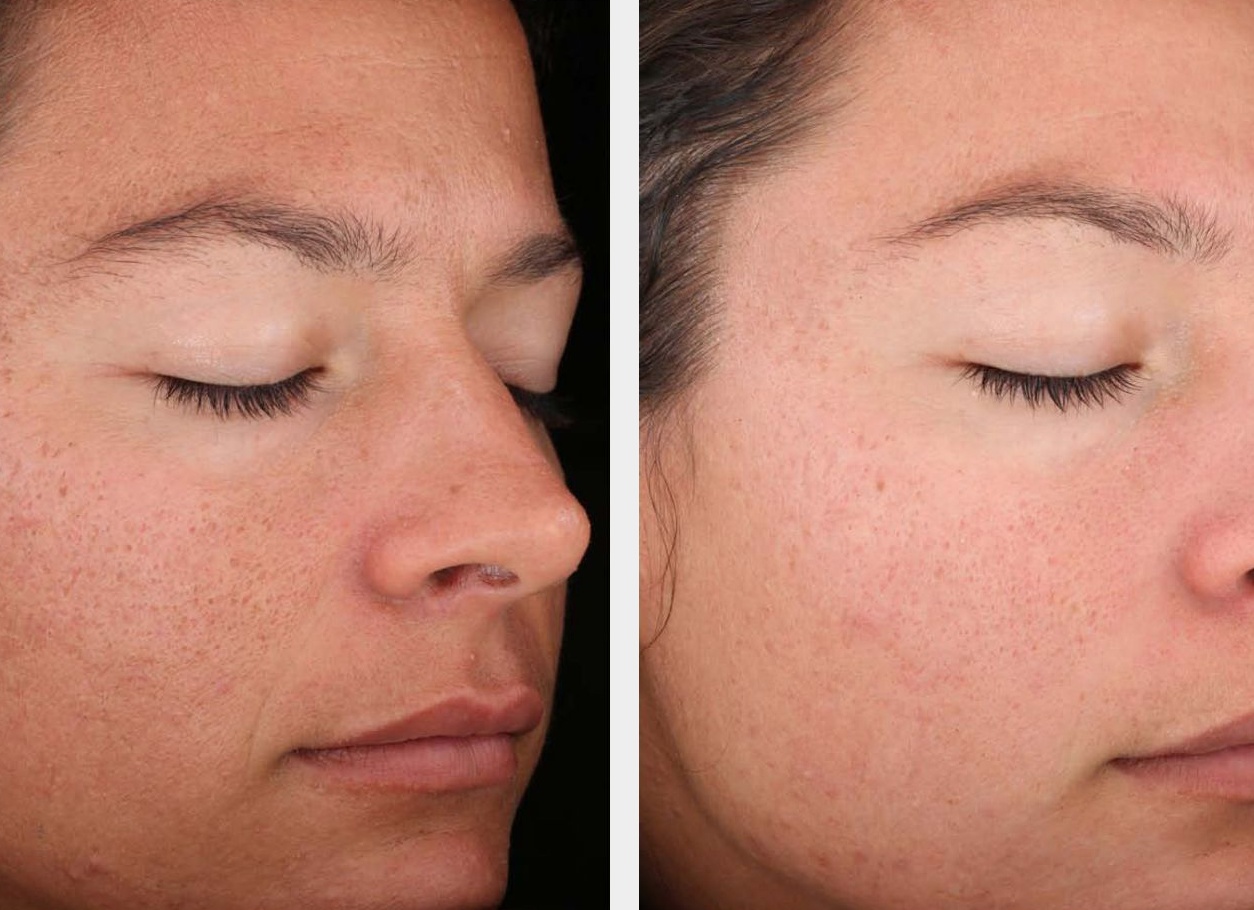 Биоревитализация кожи лица в Москве — цена процедуры, фото эффекта до после, стоимость на лучшие препараты 2025